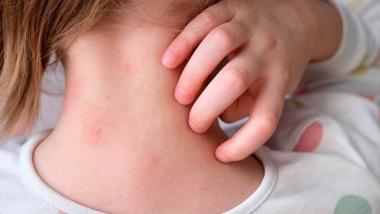 Menores de 1 a 9 años concentran más de 2 mil 400 contagios por sarampión en el país